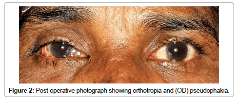 ocular-infection-inflammation-orthotropia