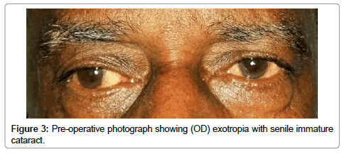 ocular-infection-inflammation-senile-immature