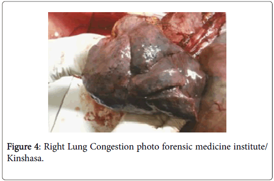 pharmacogenomics-pharmacoproteomics-Lung-Congestion