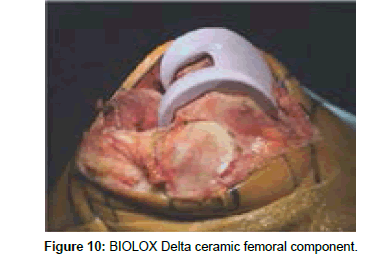 single-cell-biology-Delta-ceramic-femoral