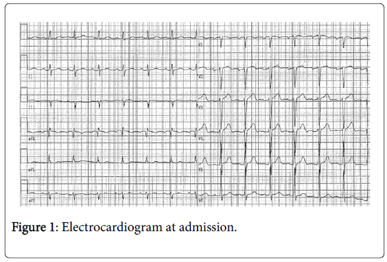 thrombosis-circulation-Electrocardiogram-admission