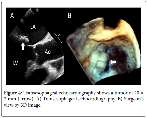 thrombosis-circulation-Transesophageal-echocardiography