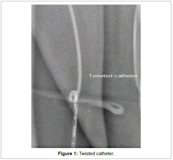 thrombosis-circulation-twisted-catheter