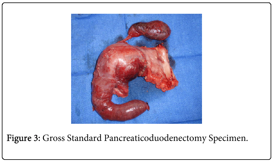 tropical-medicine-surgery-Pancreaticoduodenectomy
