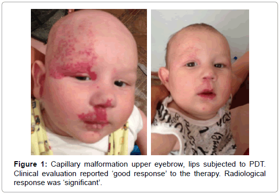 tropical-medicine-surgery-capillary-malformation-eyebrow