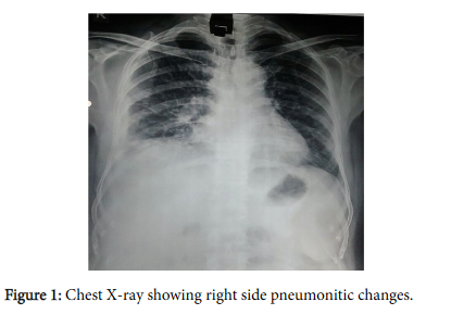 tropical-medicine-surgery-chest-pneumonitic-changes