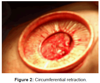 tropical-medicine-surgery-circumferential-retraction