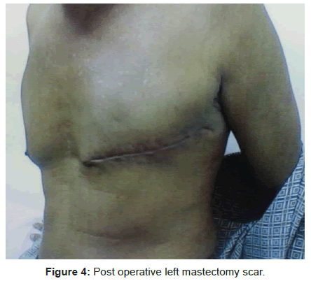 tropical-medicine-surgery-operative-mastectomy-scar