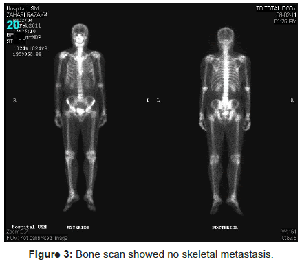 tropical-medicine-surgery-scan-skeletal-metastasis