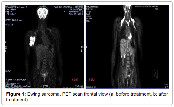 tumors-Research-Ewing-sarcoma