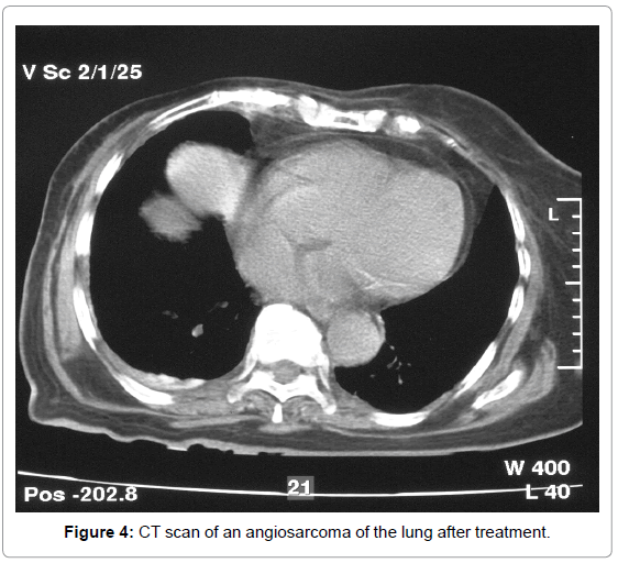 tumors-Research-lung-after-treatment
