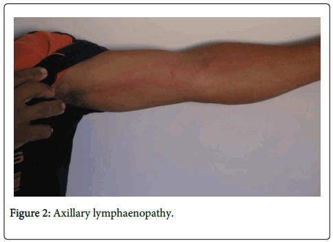 vaccines-vaccination-Axillary-lymphaenopathy