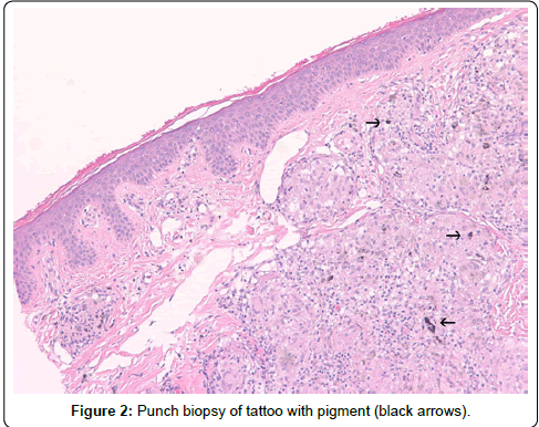 Delayed-type hypersensitivity reaction to red tattoo ink. a