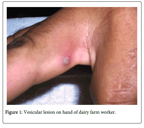 vaccines-vaccination-Vesicular-lesion