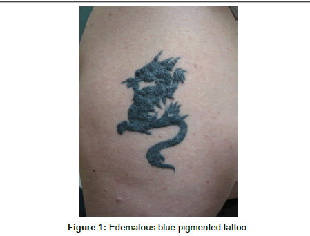Delayed-type hypersensitivity reaction to red tattoo ink. a