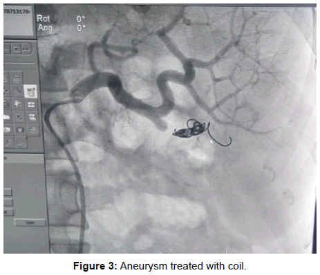 vascular-medicine-aneurysm-treated-coil