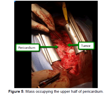vascular-medicine-spenic-artery-mass-occupying-pericardium