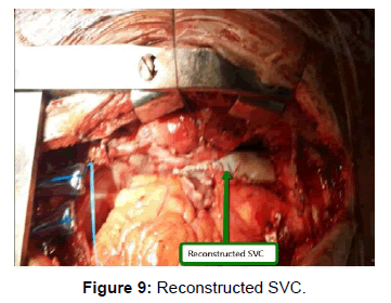 vascular-medicine-spenic-artery-reconstructed-svc