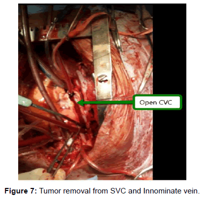 vascular-medicine-spenic-artery-tumor-removal-svc
