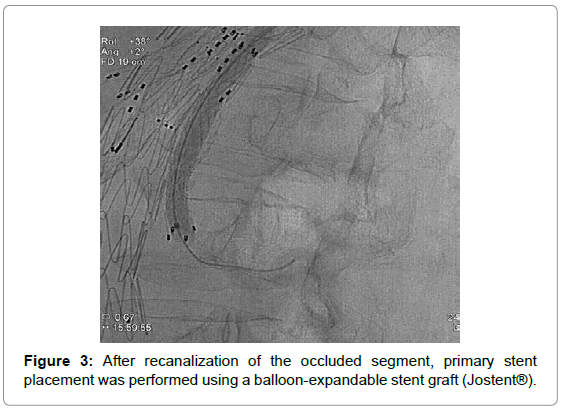 vascular-medicine-surgery-after-recanalization-occluded