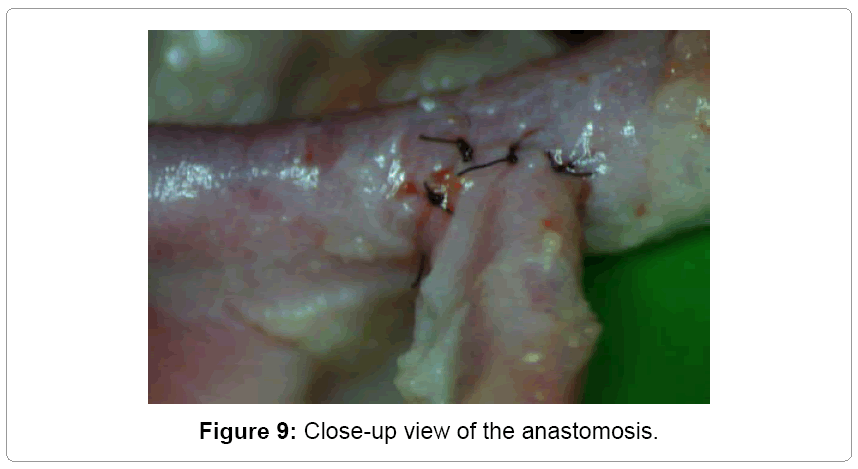 vascular-medicine-surgery-anastomosis