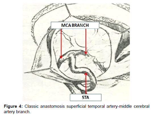 vascular-medicine-surgery-anastomosis-superficial-temporal