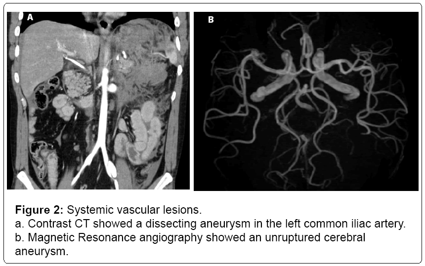 vascular-medicine-surgery-aneurysm