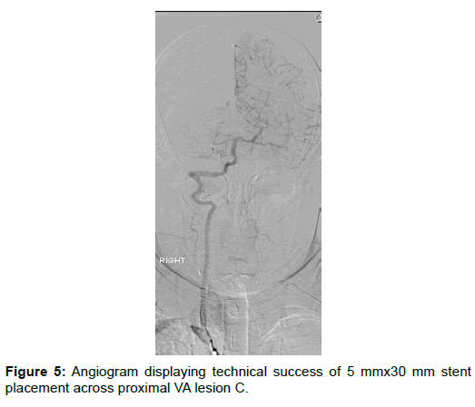 vascular-medicine-surgery-angiogram-placement-proximal