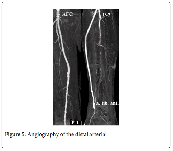 vascular-medicine-surgery-angiography-distal-arterial