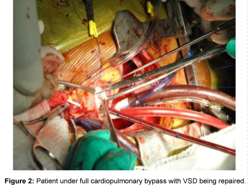 vascular-medicine-surgery-cardiopulmonary-bypass