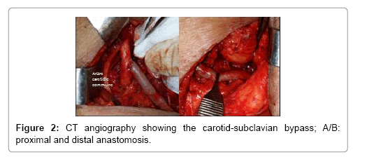 vascular-medicine-surgery-carotid-subclavian