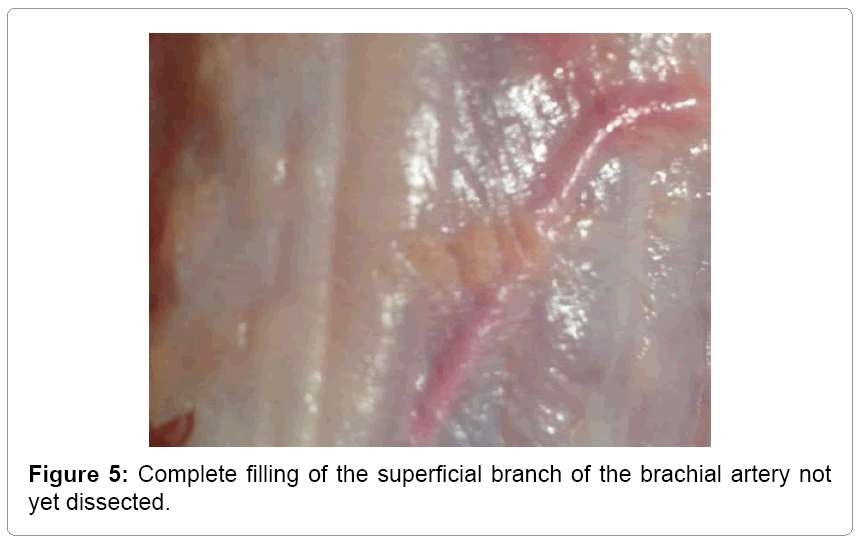 vascular-medicine-surgery-dissected