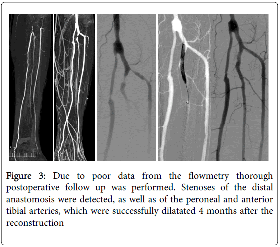 vascular-medicine-surgery-due-poor-flowmetry