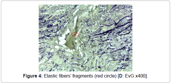 vascular-medicine-surgery-elastic-fibers-fragments