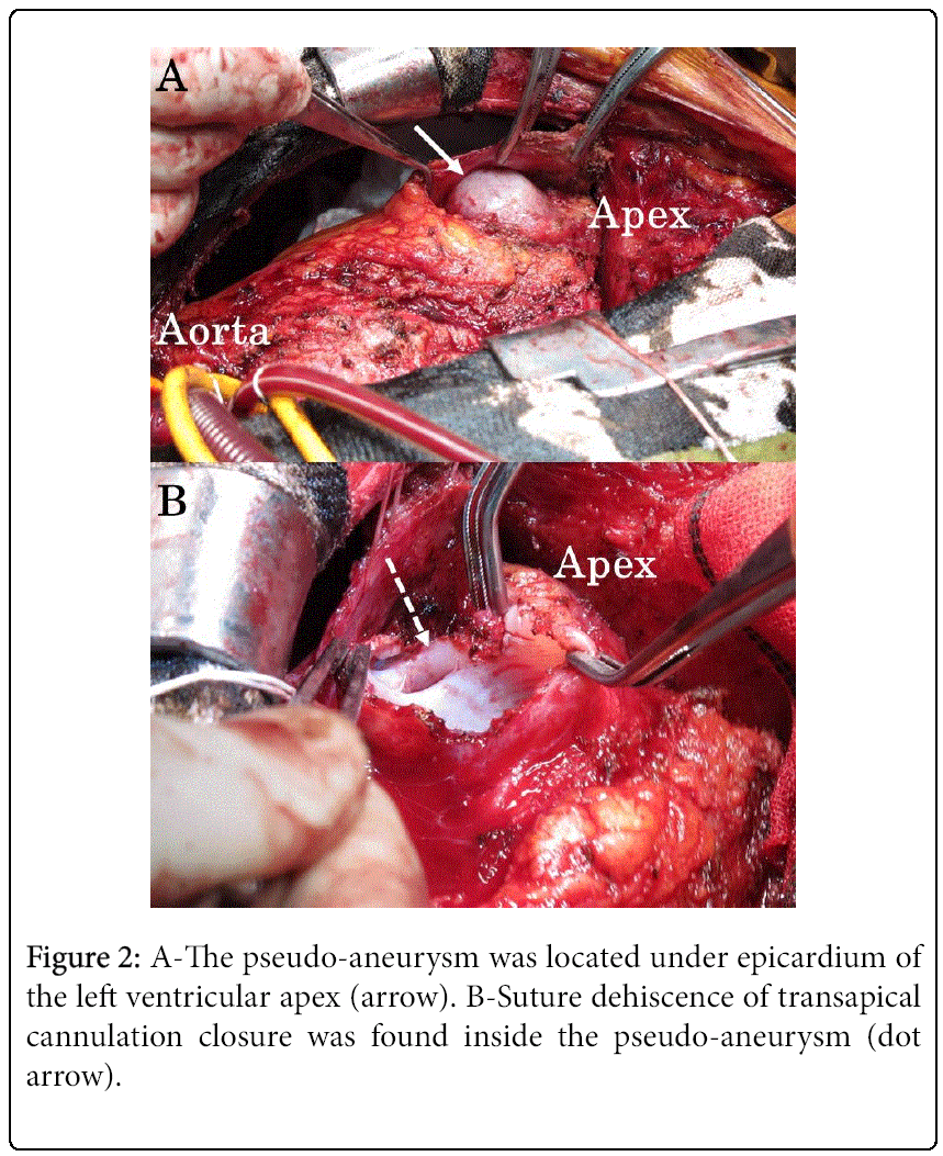vascular-medicine-surgery-epicardium
