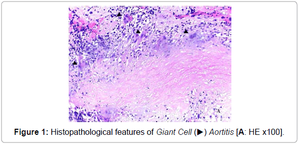 vascular-medicine-surgery-histopathological-features-giant-cell