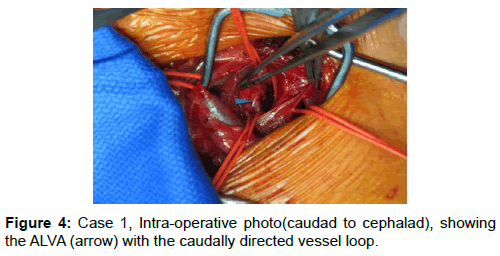 vascular-medicine-surgery-intra-operative-cephalad