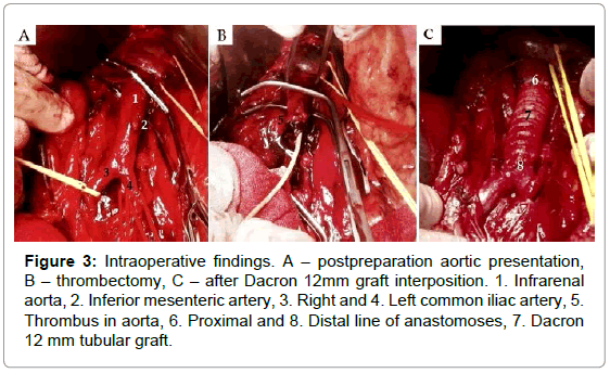 vascular-medicine-surgery-intraoperative-aortic-thrombectomy