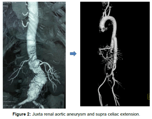 vascular-medicine-surgery-renal-aortic-aneurysm