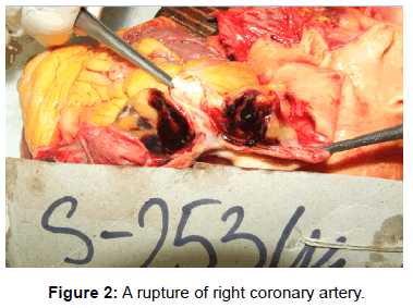 vascular-medicine-surgery-rupture-coronary-artery