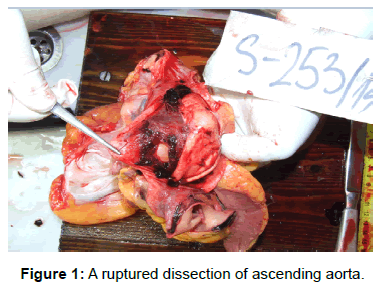 vascular-medicine-surgery-ruptured-dissection-aorta