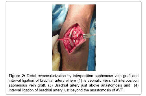 vascular-medicine-surgery-saphenous