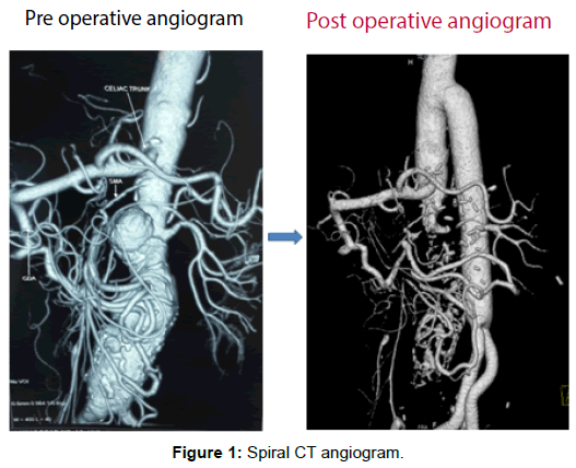 vascular-medicine-surgery-spiral-angiogram