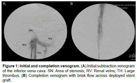 vascular-medicine-surgery-subtraction-venogram-inferior