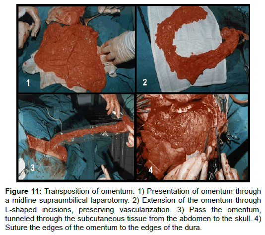 vascular-medicine-surgery-transposition-omentum-supraumbilical