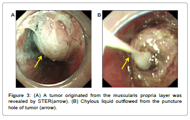 vascular-medicine-surgery-tumor-originated