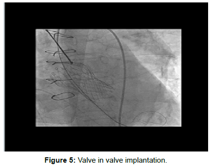 vascular-medicine-surgery-valve-implantation